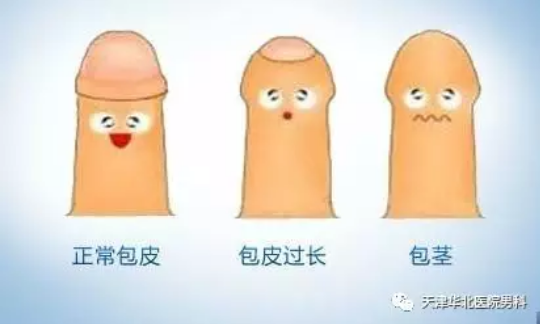 金华婺城区婺城区看一分钟 受益终生--解读男性包皮过长
